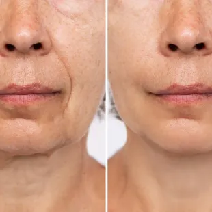 LIROMA® LED THERAPEUTIC RED LIGHT AND NEAR INFRARED FACE, NECK AND DÉCOLLETÉ MASK